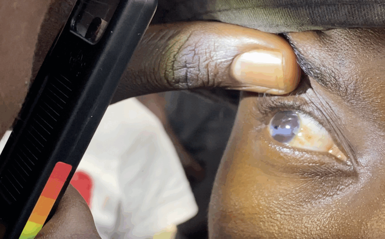 Corneal Examination